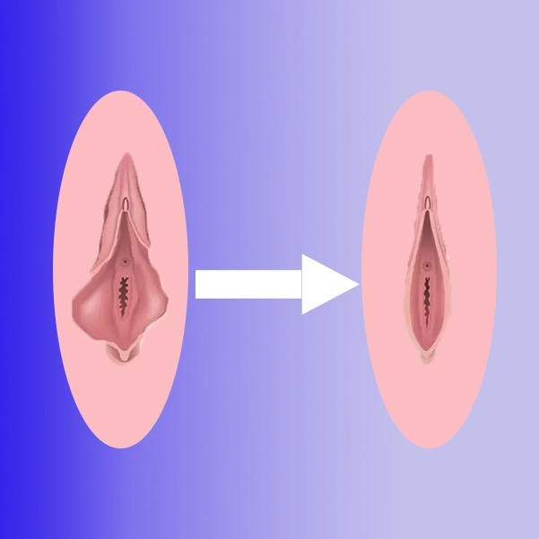 لابیاپلاستی چیست