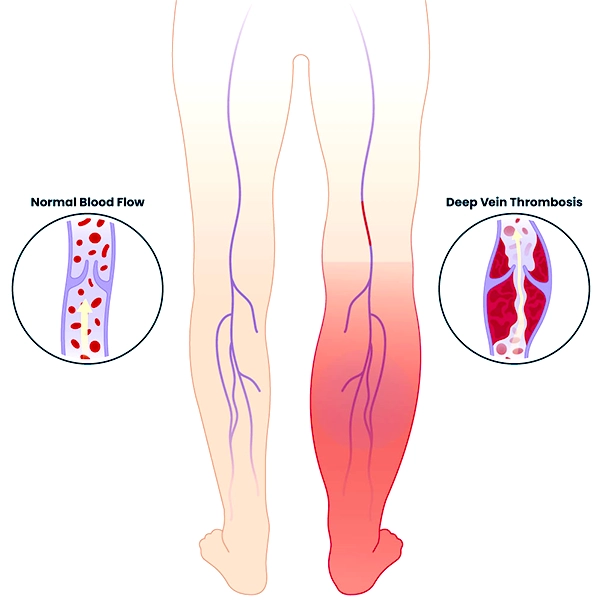 علل ترومبوز وریدی در بارداری