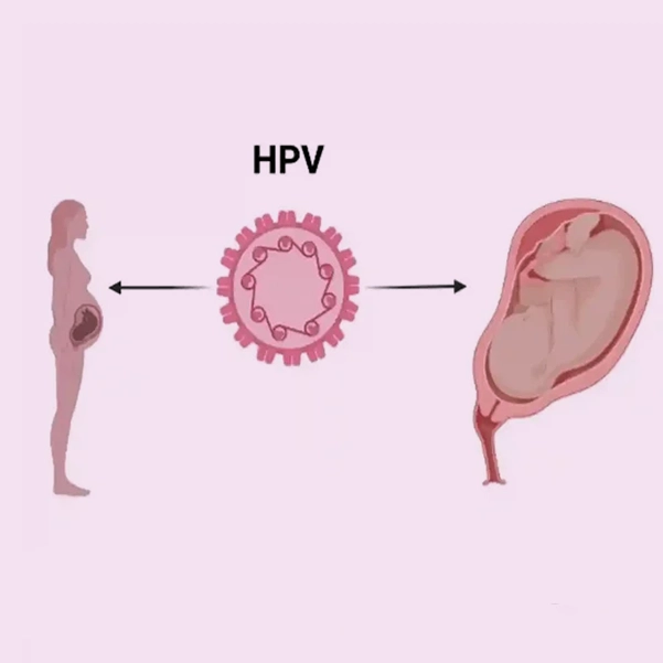 انتقال HPV از مادر به کودک