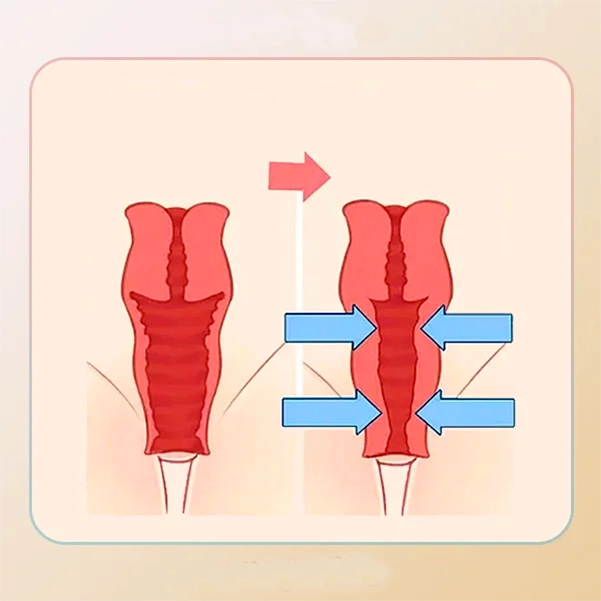 نحوه عملکرد نخ آپتوس واژینال