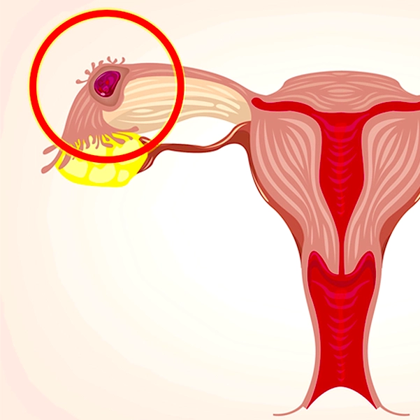 روش‌های تشخیص حاملگی خارج رحم