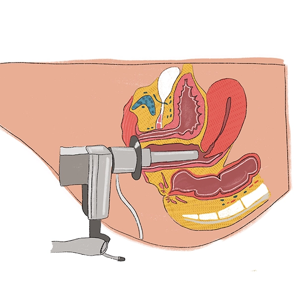 لیزر مونالیزا (Monalisa Touch)