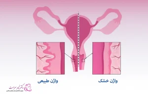 درمان اتروفی و خشکی واژن
