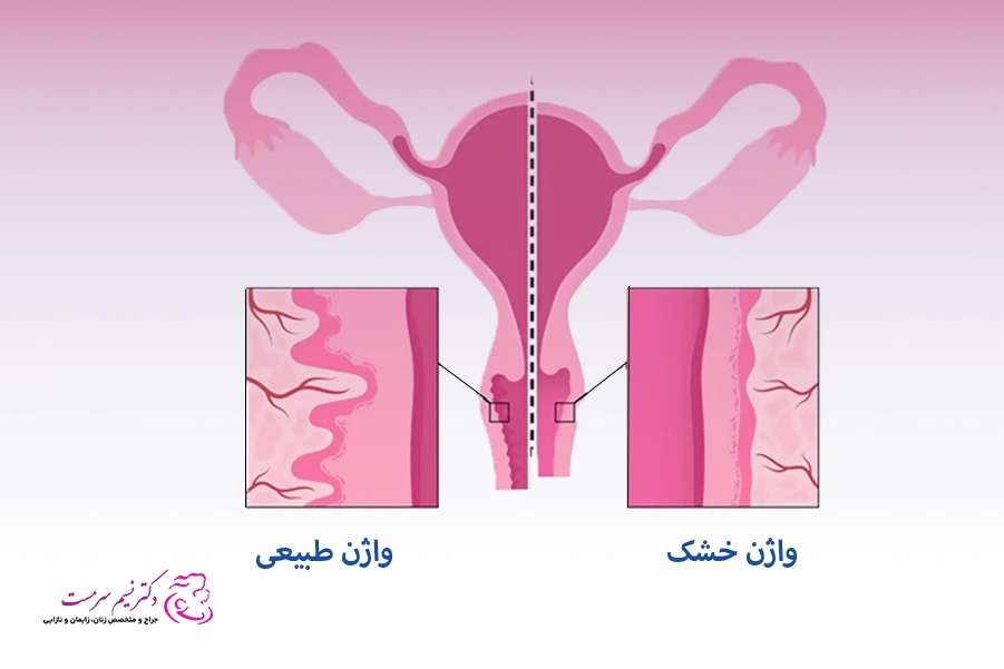 درمان اتروفی و خشکی واژن