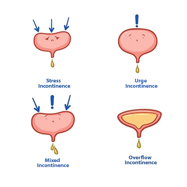 انواع بیاختیاری ادرار