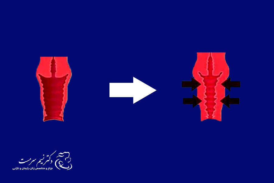 جوانسازی واژن