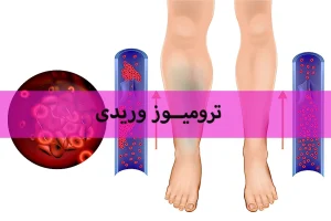 ترومیوز وریدی در بارداری چیست؟