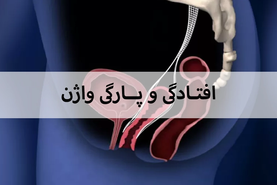 ترمیم افتادگی و پارگی واژن