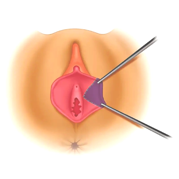 روش انجام هودکتومی