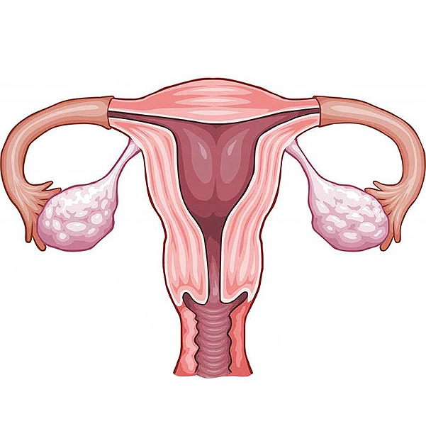 دلایل انجام هیسترکتومی