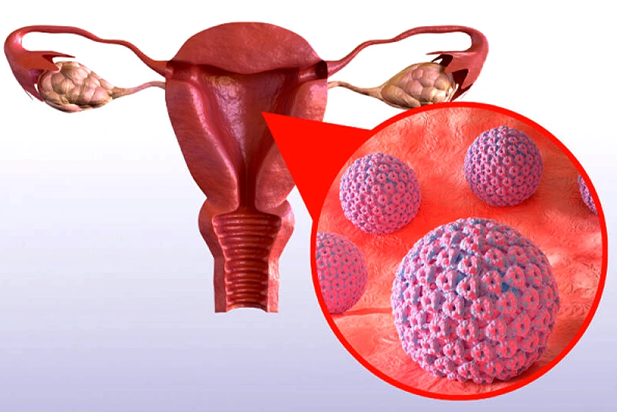 علائم و راه های تشخیص سرطان دهانه رحم