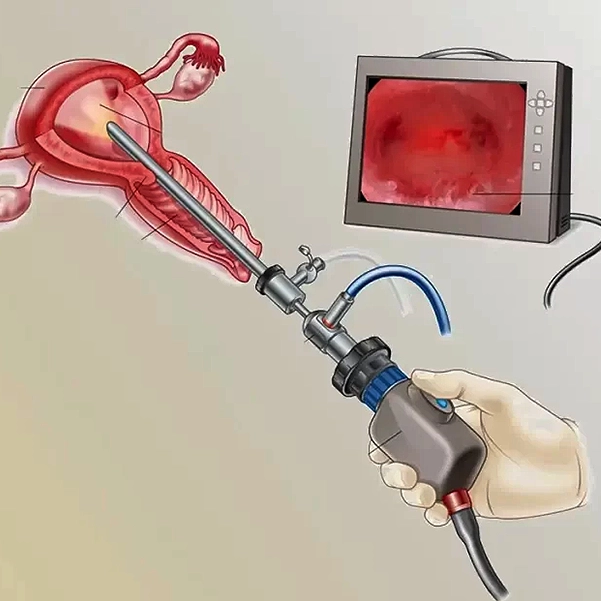 انوع هیستروسکوپ