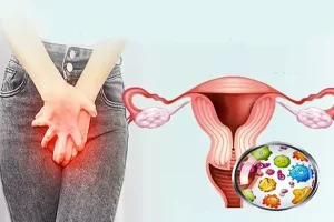 عفونت واژن، عوامل و درمان