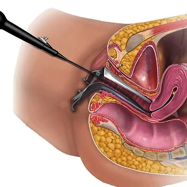 روند انجام هیستروسکوپی چگونه است؟