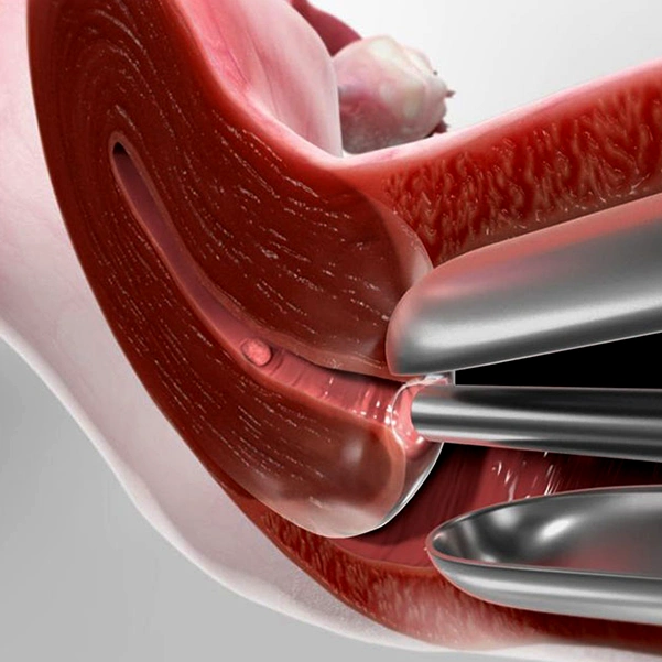 هیستروسکوپی چیست؟