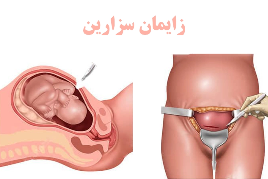 زایمان سزارین