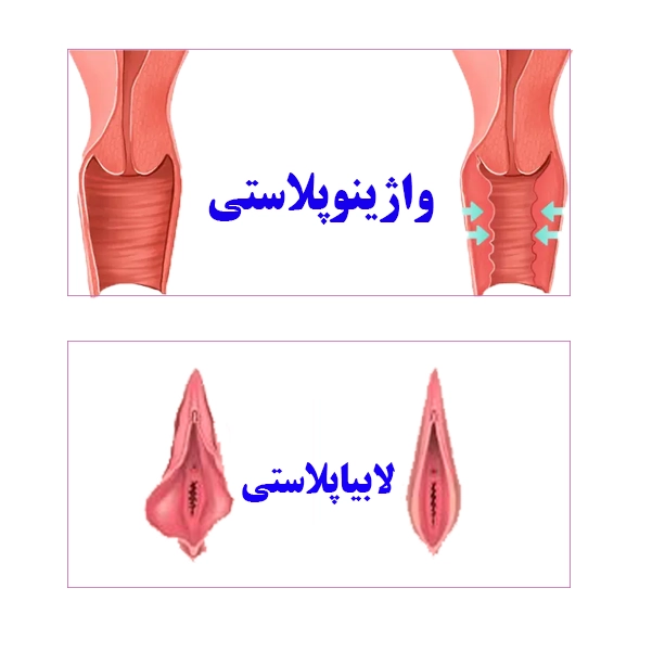 تفاوت واژینوپلاستی با لابیاپلاستی