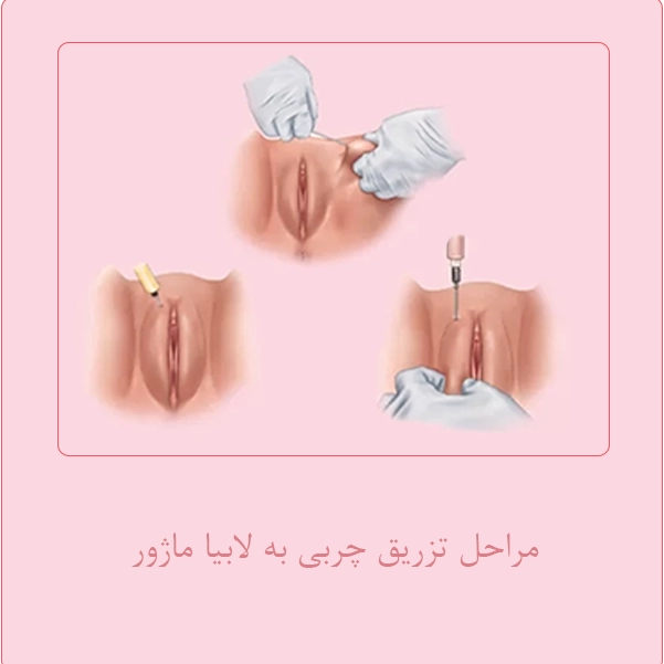 لابیاپلاستی - تزریق چربی به لابیا ماژور