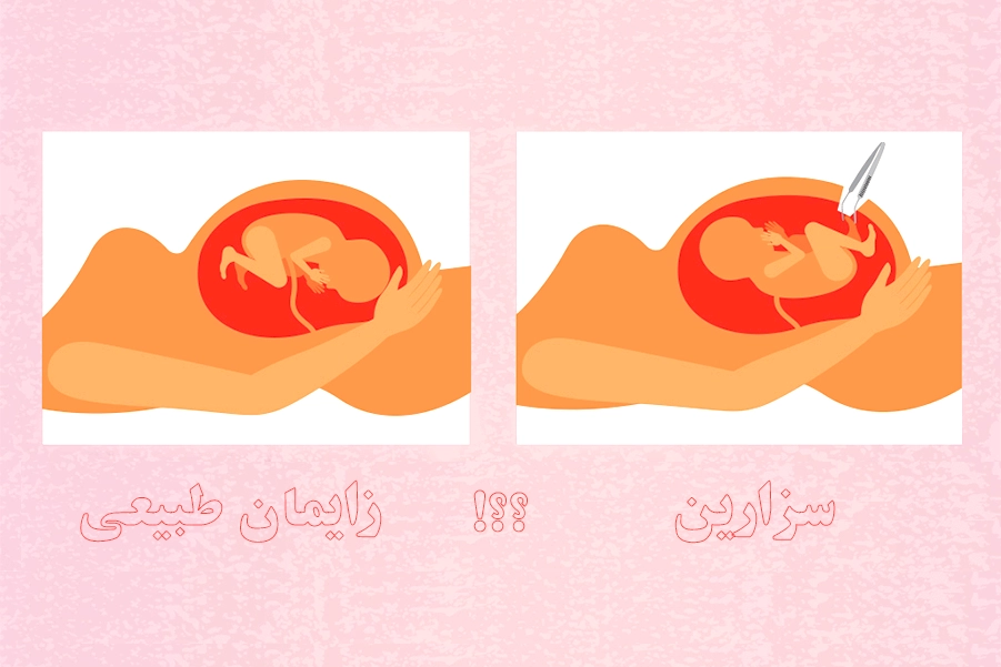 زایمان طبیعی یا سزارین: مزایا و معایب هر روش