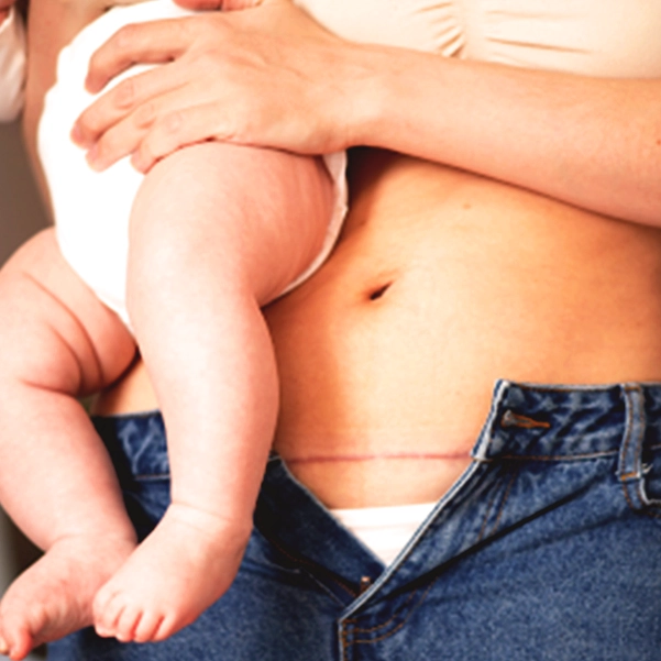 دوره نقاهت پس از سزارین