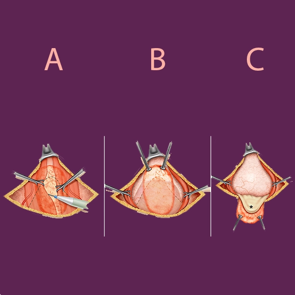 مراحل انجام زایمان سزارین