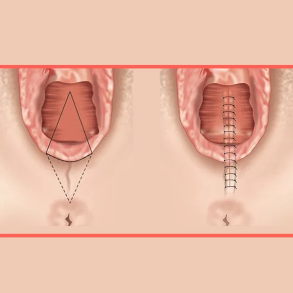 مراحل انجام واژینوپلاستی