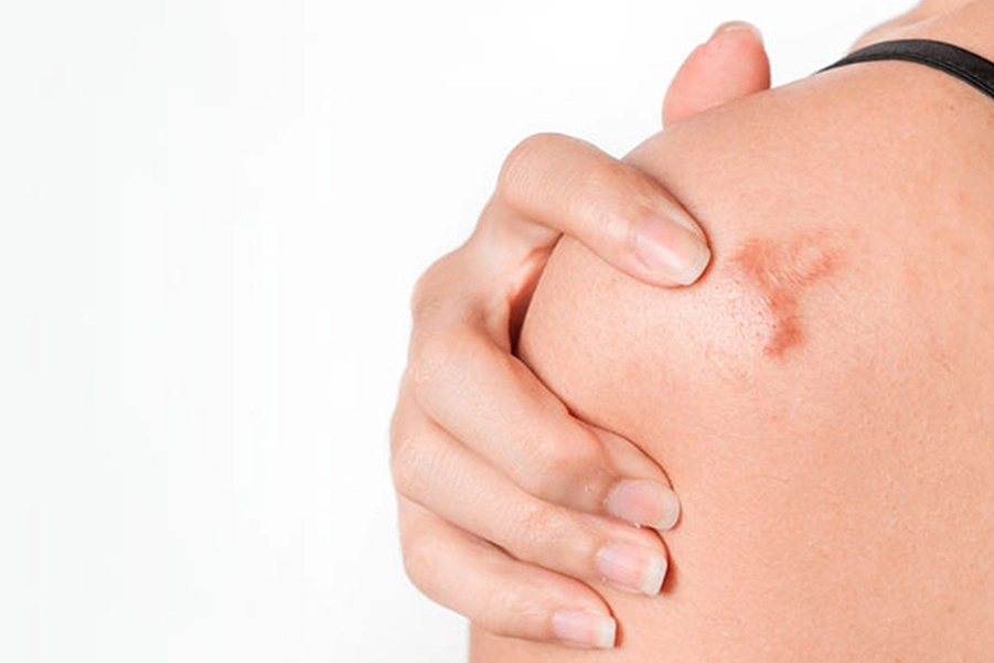 درمان کلوئید و جای زخم