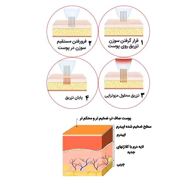 استفاده از مزوتراپی یا مزوایت برای رفع تیرگی واژن