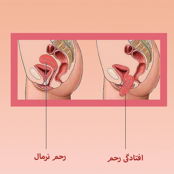 جراحی افتادگی رحم