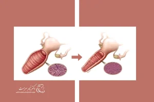 عمل تنگ کردن واژن