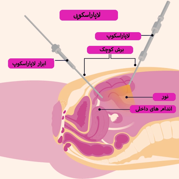 لاپاراسکوپی چیست؟