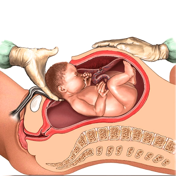 سزارین چیست؟