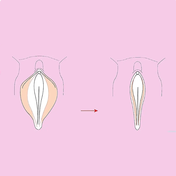 مراحل انجام لیفت واژن