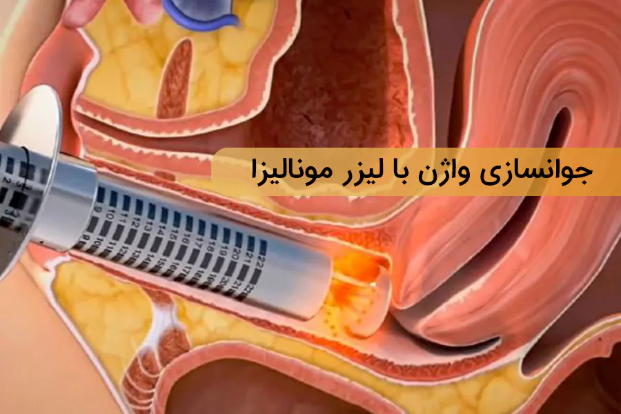 جوانسازی واژن با لیزر مونالیزا